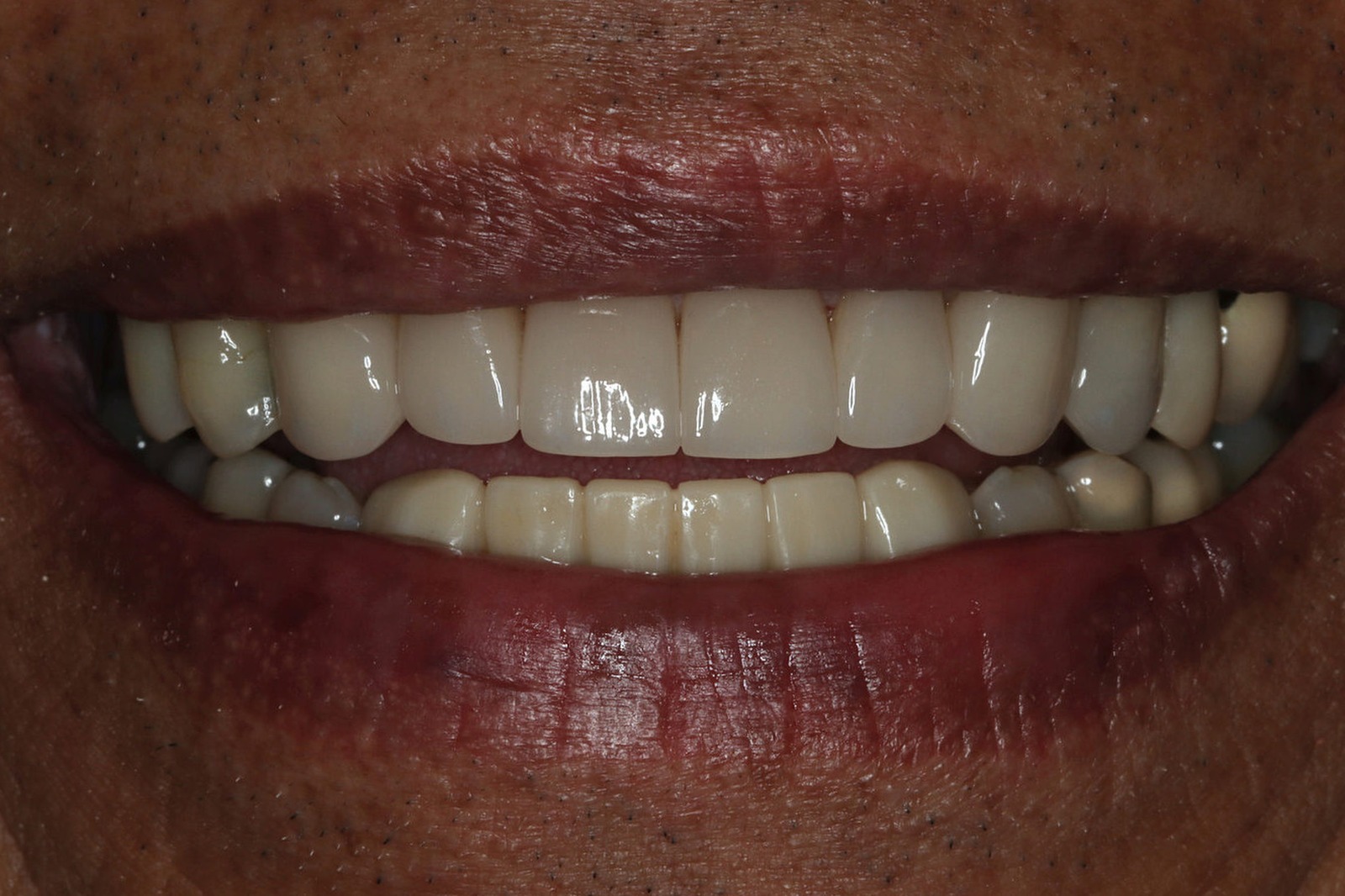 After cosmetic treatment: an even, natural-looking restored upper smile on the same Bonin Dental Care patient