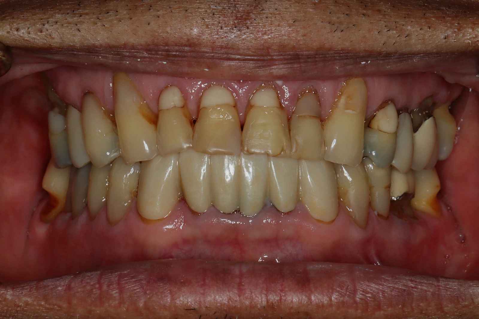Before cosmetic treatment: worn, crowded, and discolored upper teeth on an actual Bonin Dental Care patient
